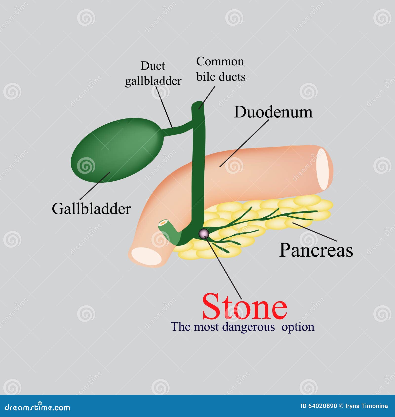stone pancreatic bile duct. the gall bladder, duodenum, bile ducts.   on a gray background