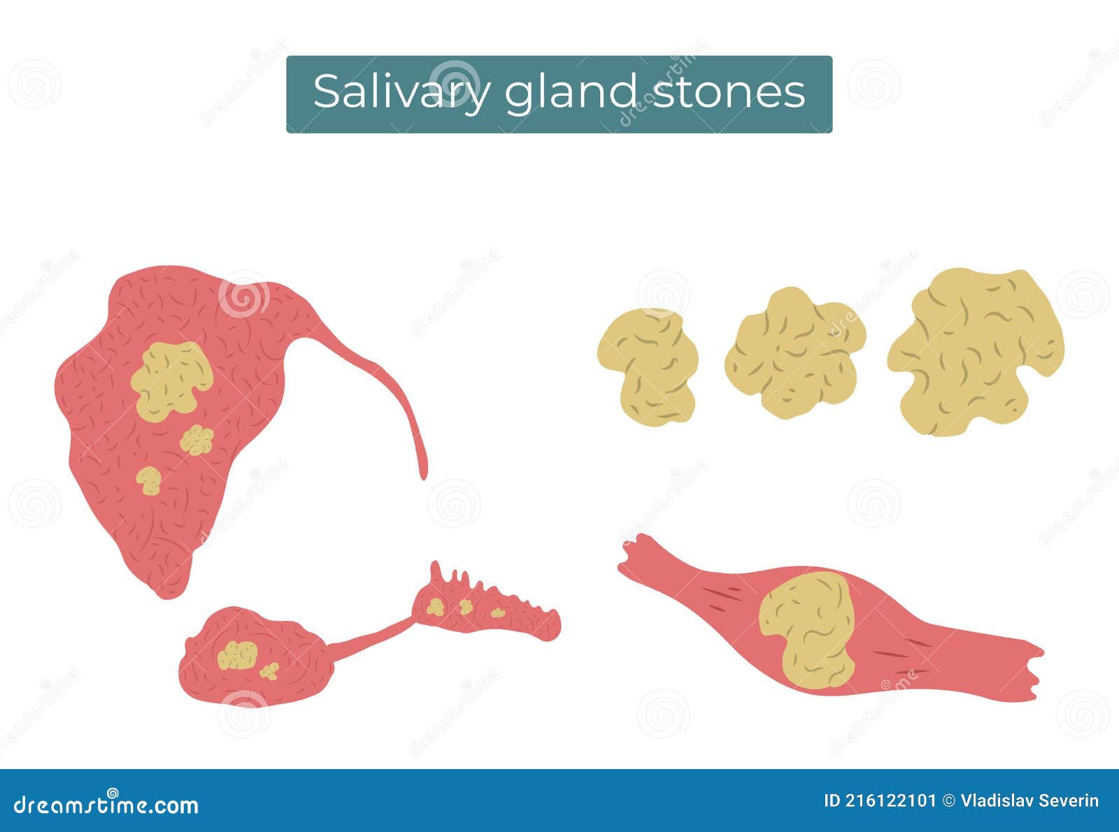 stones in the parotid, submandibular and sublingual salivary glands and duct