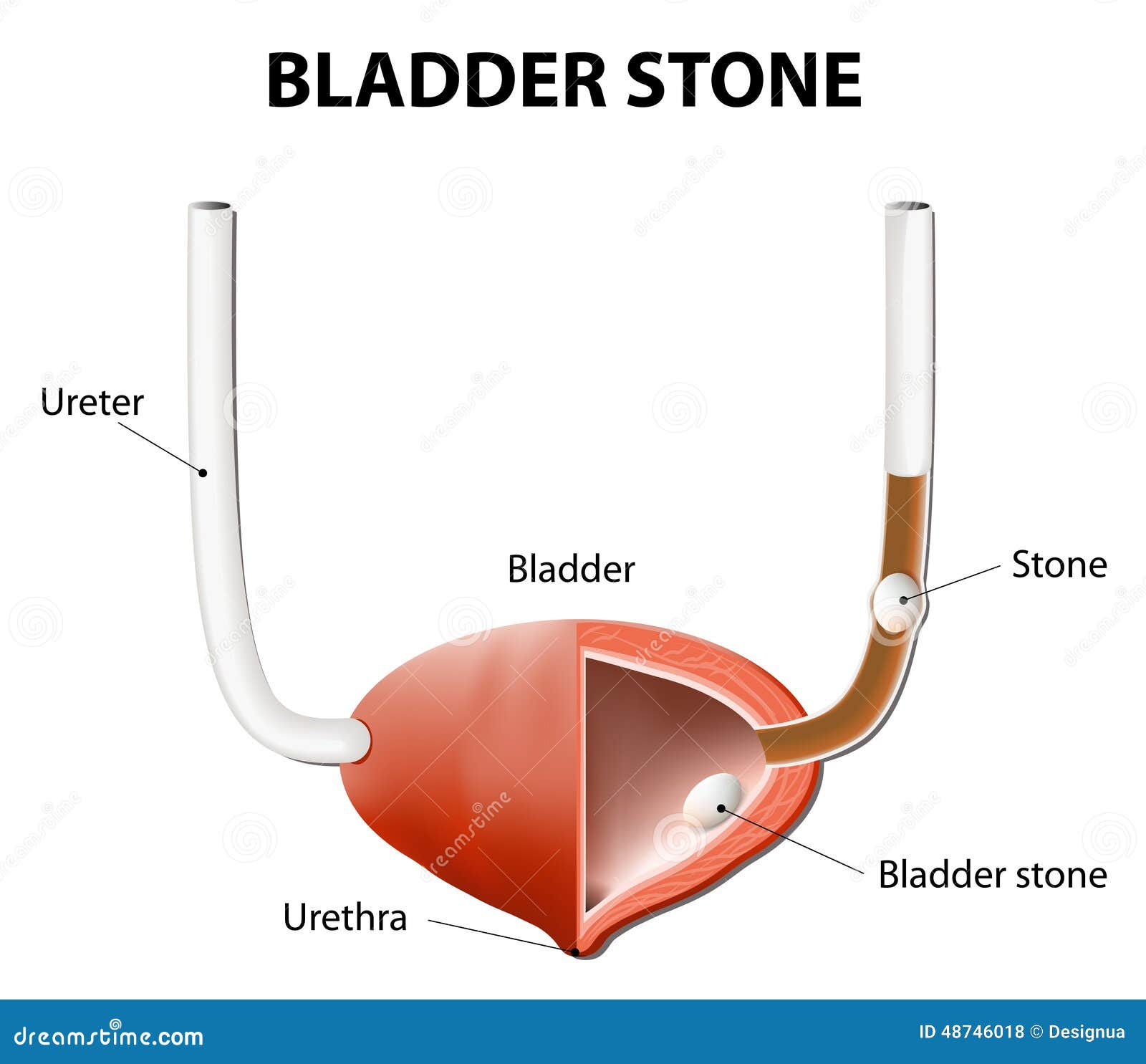 Stones In The Urinary Bladder And Ureter Stock Vector