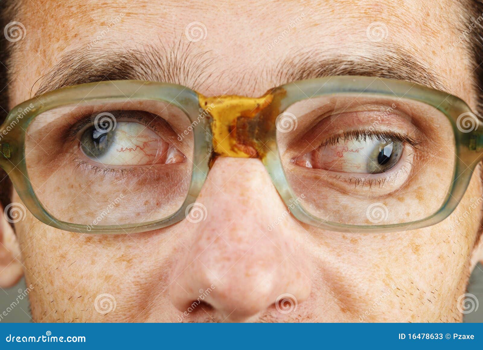 strabismus - eye closeup