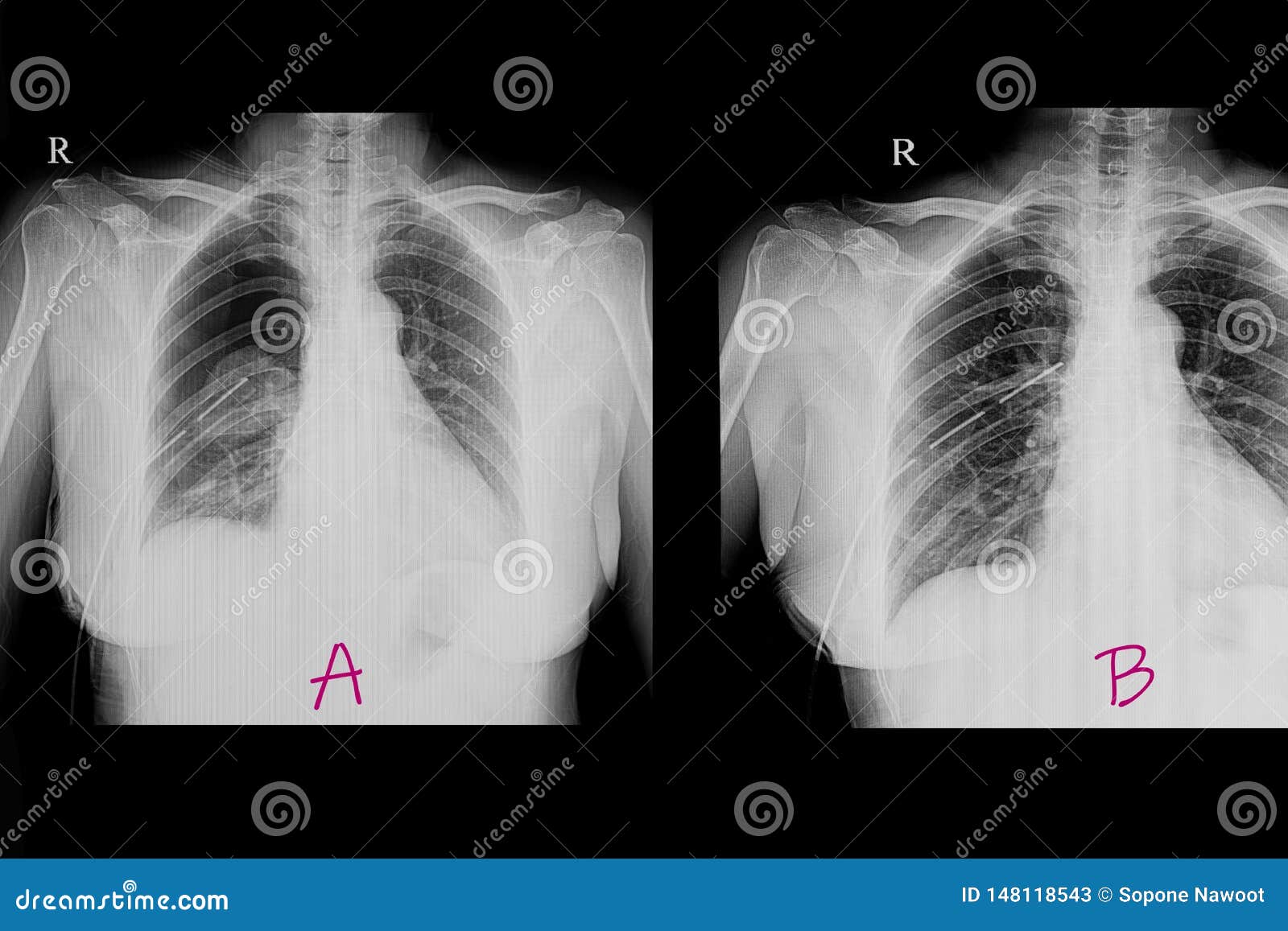 Strahlnfilm Des Kastens X Eines Patienten Mit Pneumothorax Stockbild Bild Von Luft Strahlung 148118543