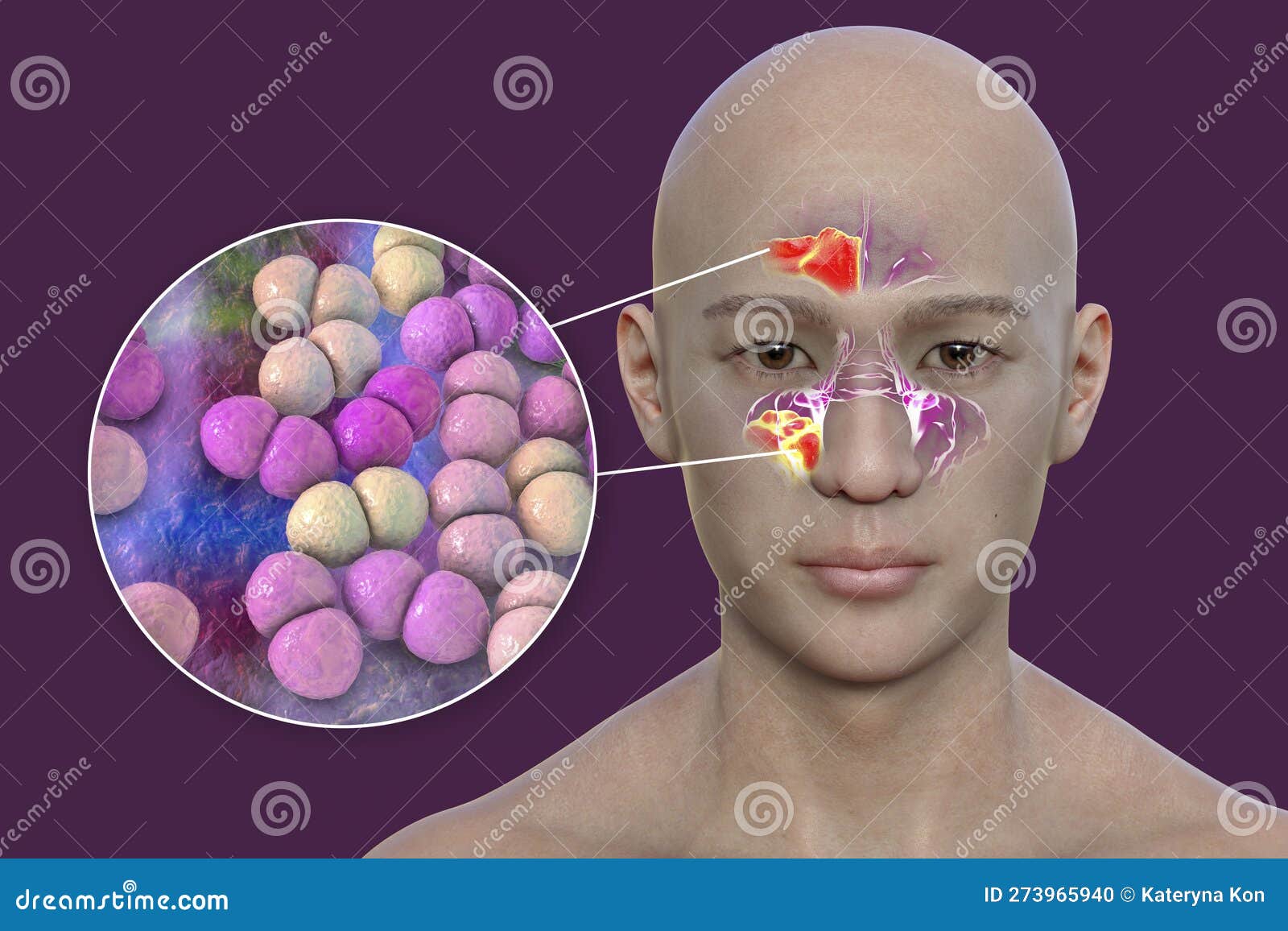 Streptococcus Pneumoniae Bacteria As A Cause Of Sinusitis 3D streptococcus-pneumoniae-bacteria-as-a-cause-of-sinusitis-3d