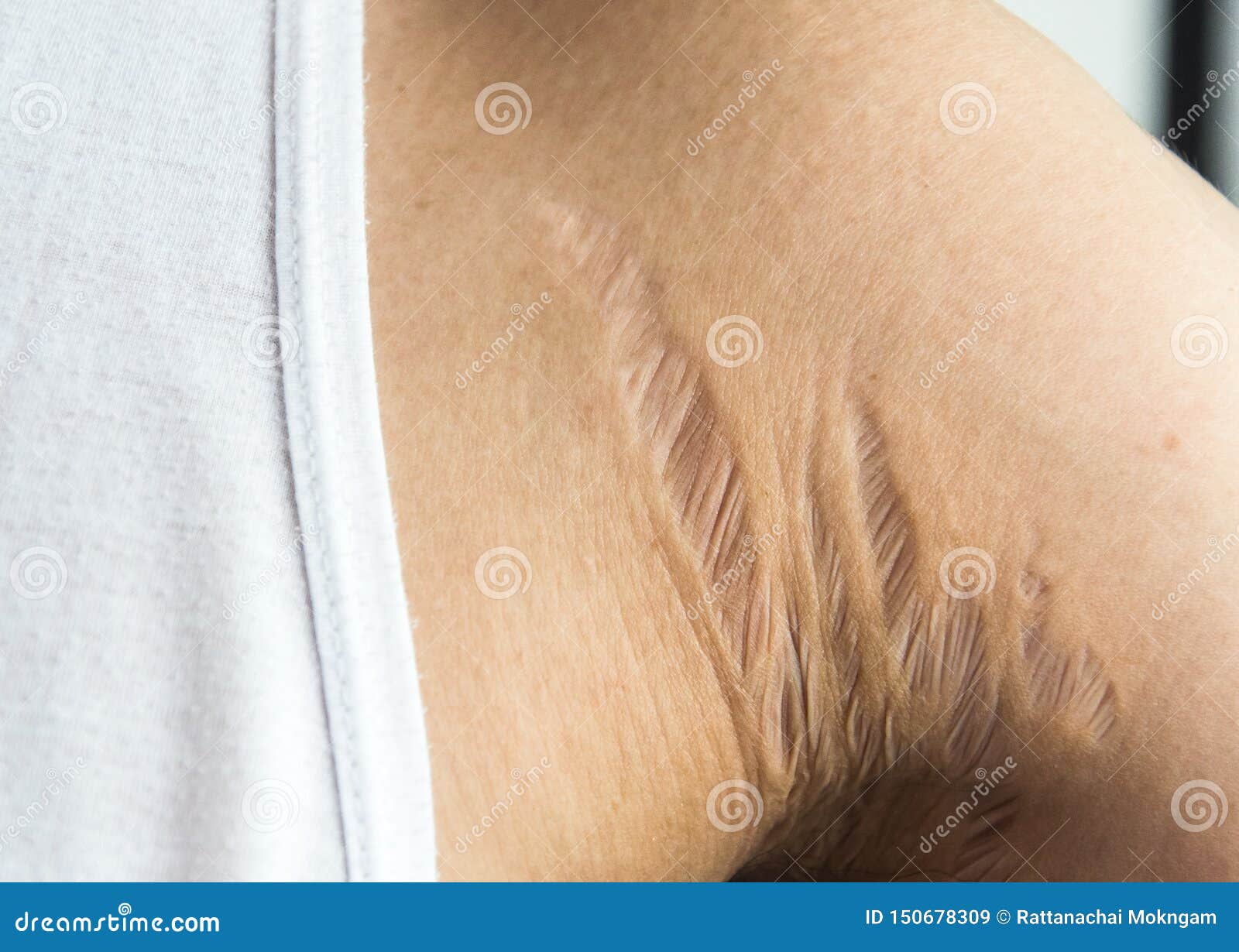 stretch marks on armpit skin area caused by tearing of the dermis layer of the skin prednisolone`s side effect