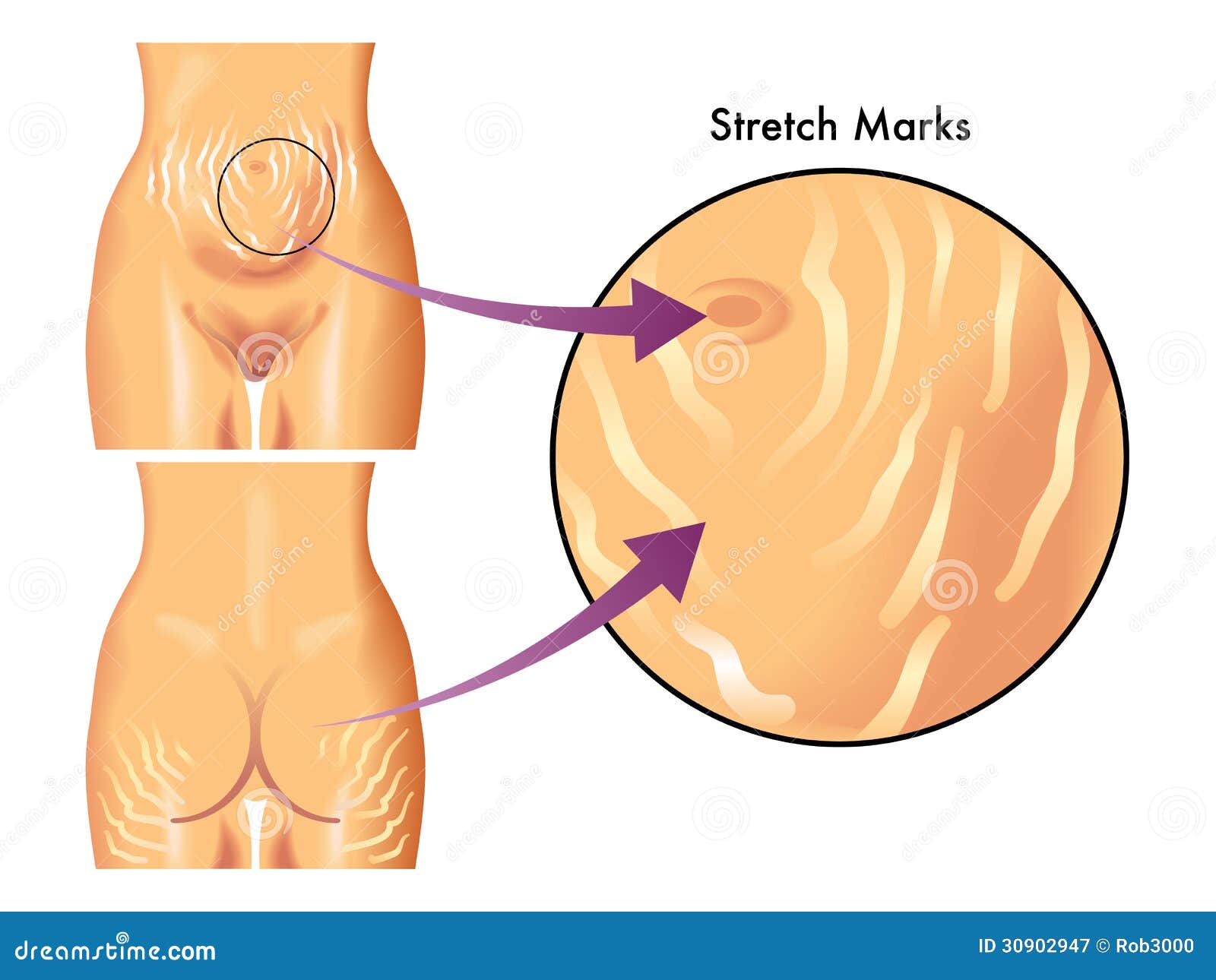 stretch marks