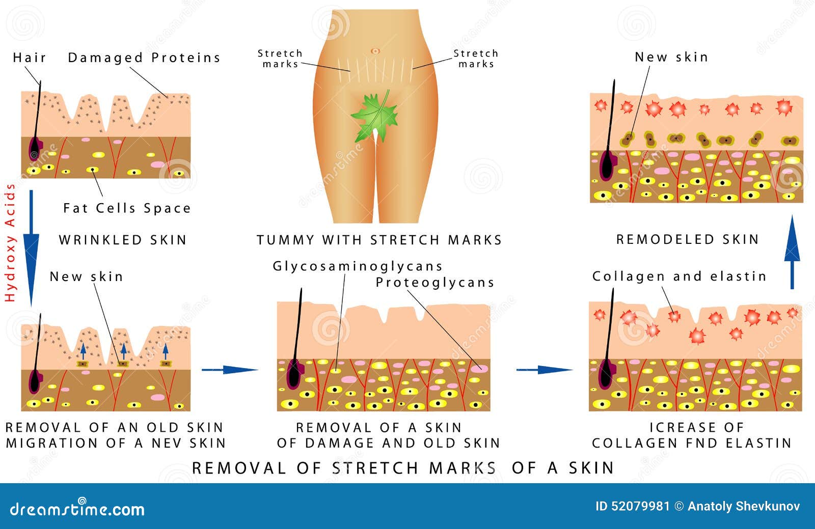 Stretch Marks Of A Skin Stock Vector - Image: 52079981