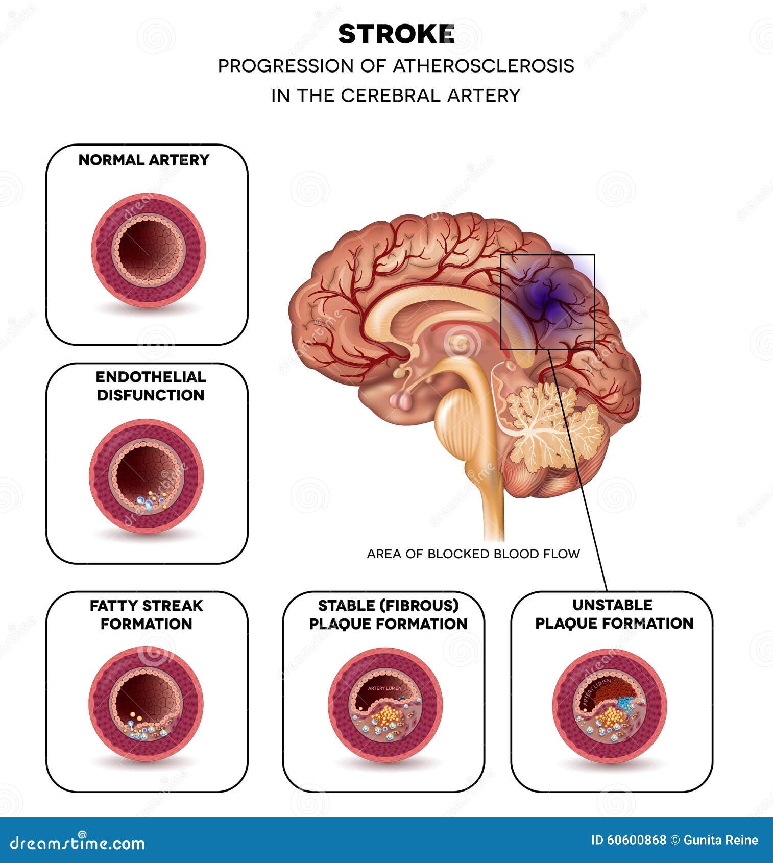 Stroke In The Brain Artery Stock Vector  Illustration Of