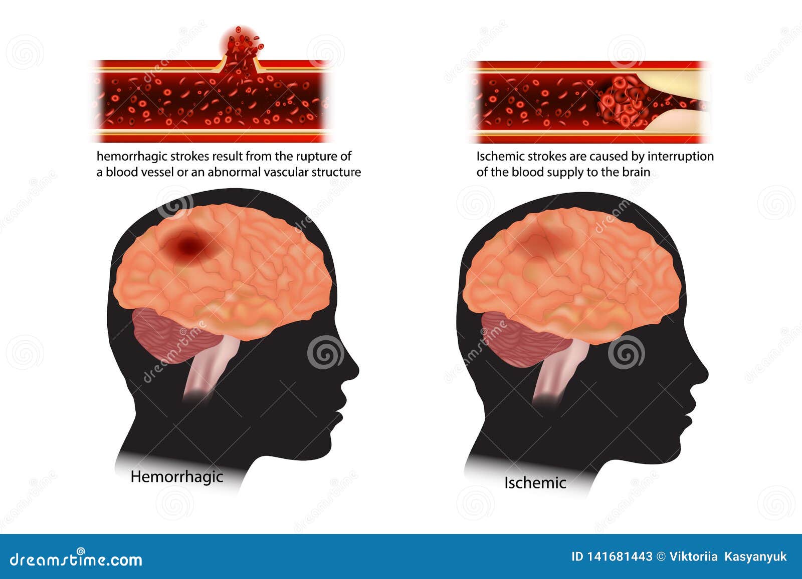 Strokes Classified Ischemic And Hemorrhagic Stock Vector