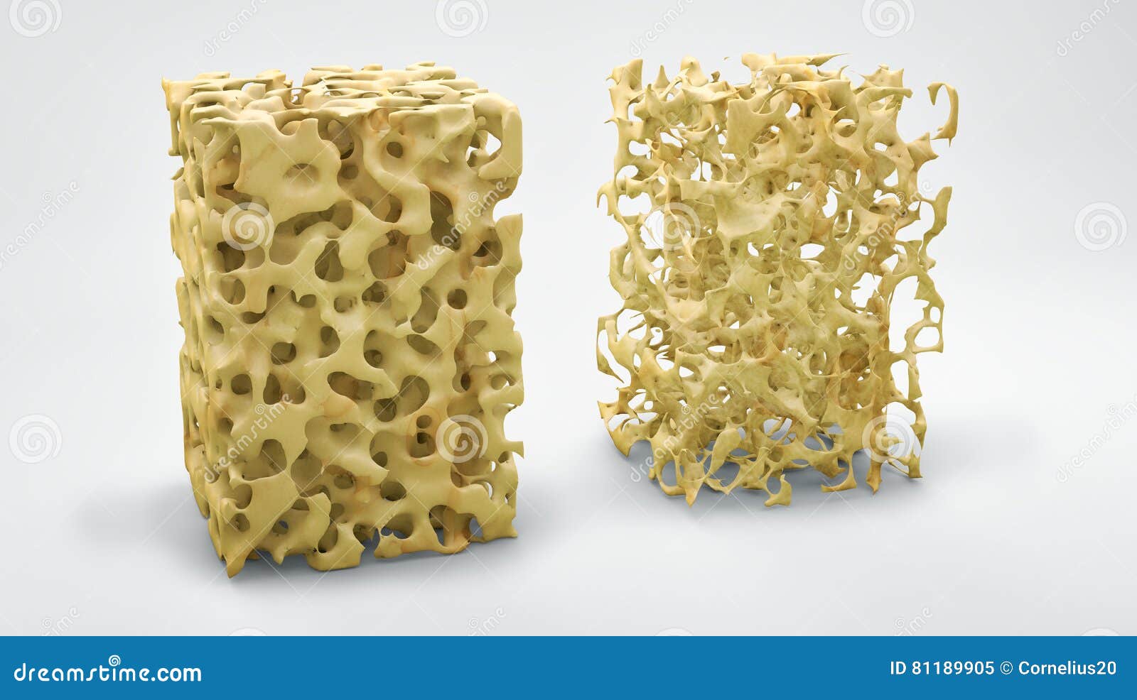 Structure D'os, Normale Et Avec L'ostéoporose Illustration Stock