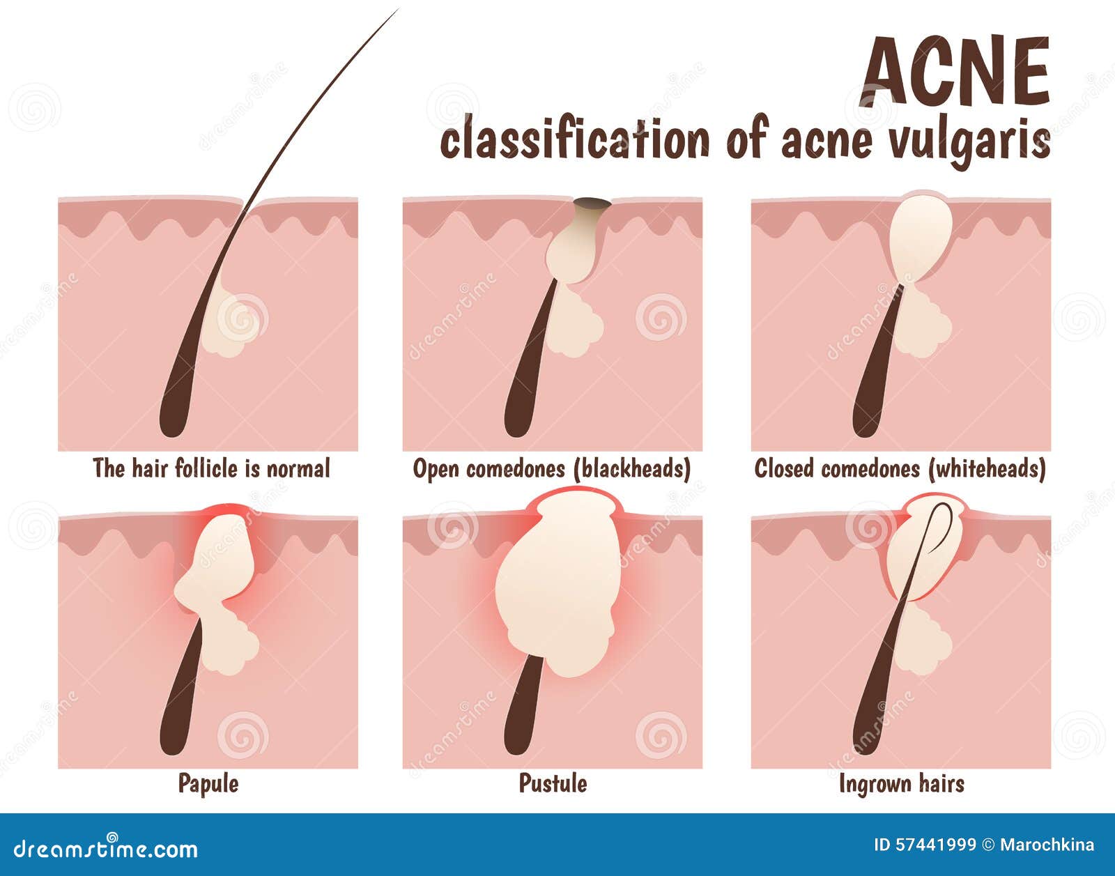 Structure of the Hair Follicle Stock Vector - Illustration of acne, inflammation: 57441999 Structure of the Hair Follicle Stock Vector - Illustration of acne, inflammation: 57441999