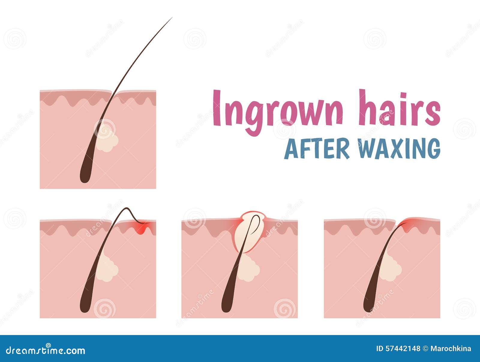 Structuur Van Het Haarfollikel Vector Illustratie Illustration of