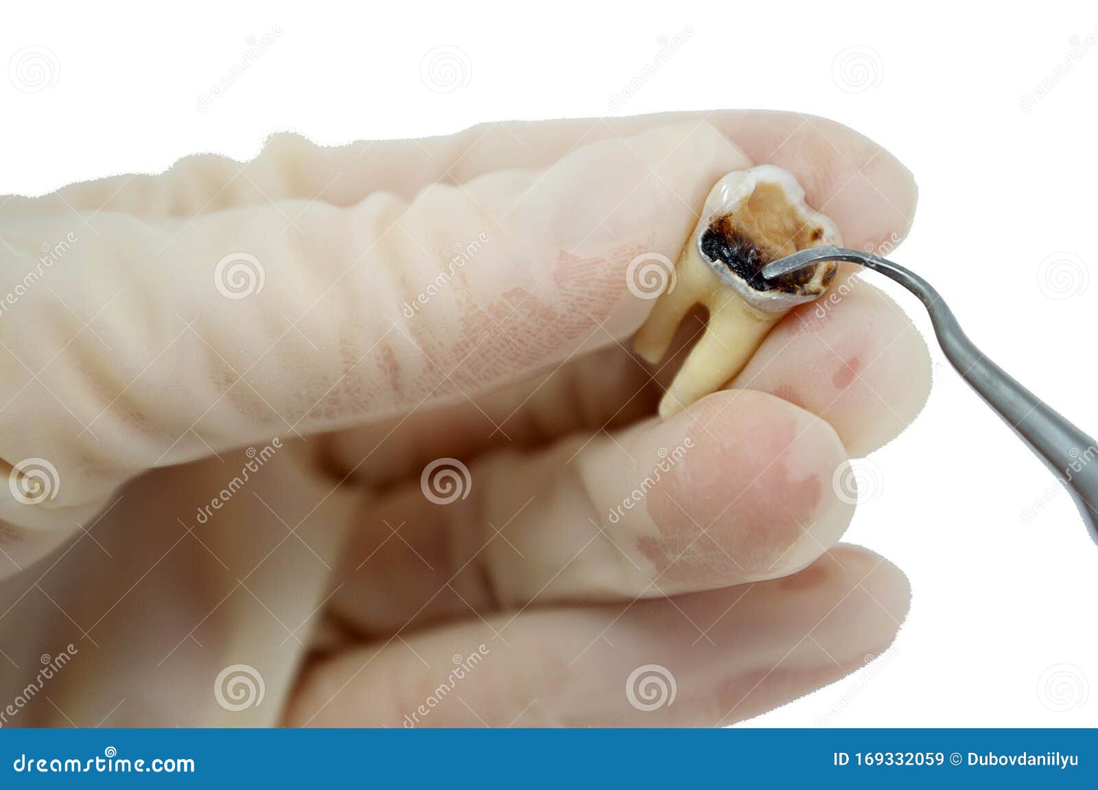 Study of the Carious Cavity of the Destroyed Caries Tooth Stock Image