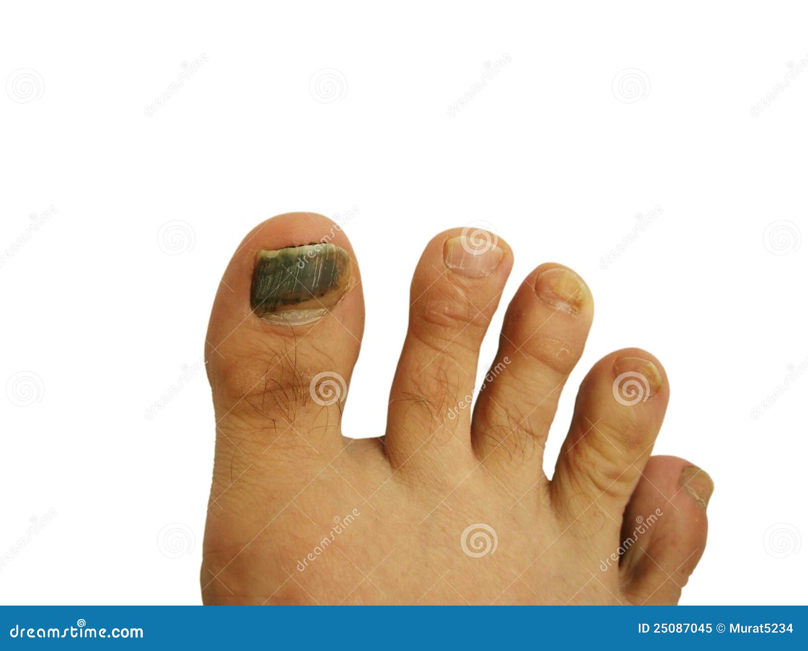 Почернение ногтя большого пальца ноги