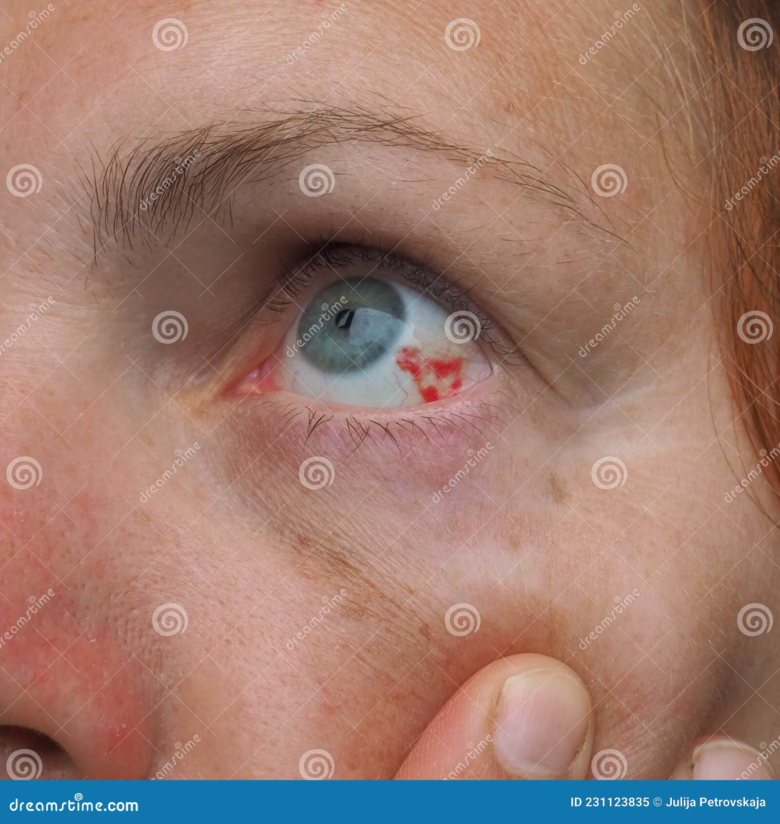 Subconjunctival Hemorrhage Or Subconjunctival Bleeding Hyposhagmus