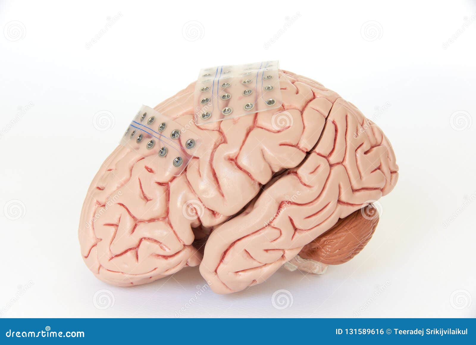 Subdural Grid Electrode for Brain Waves Recording or