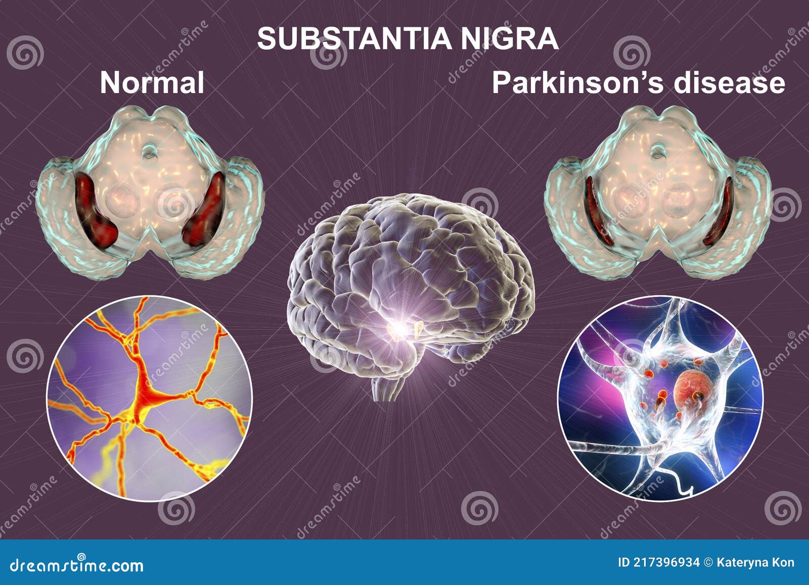 substantia nigra of the midbrain and its dopaminergic neurons in normal state and in parkinson's disease, 3d