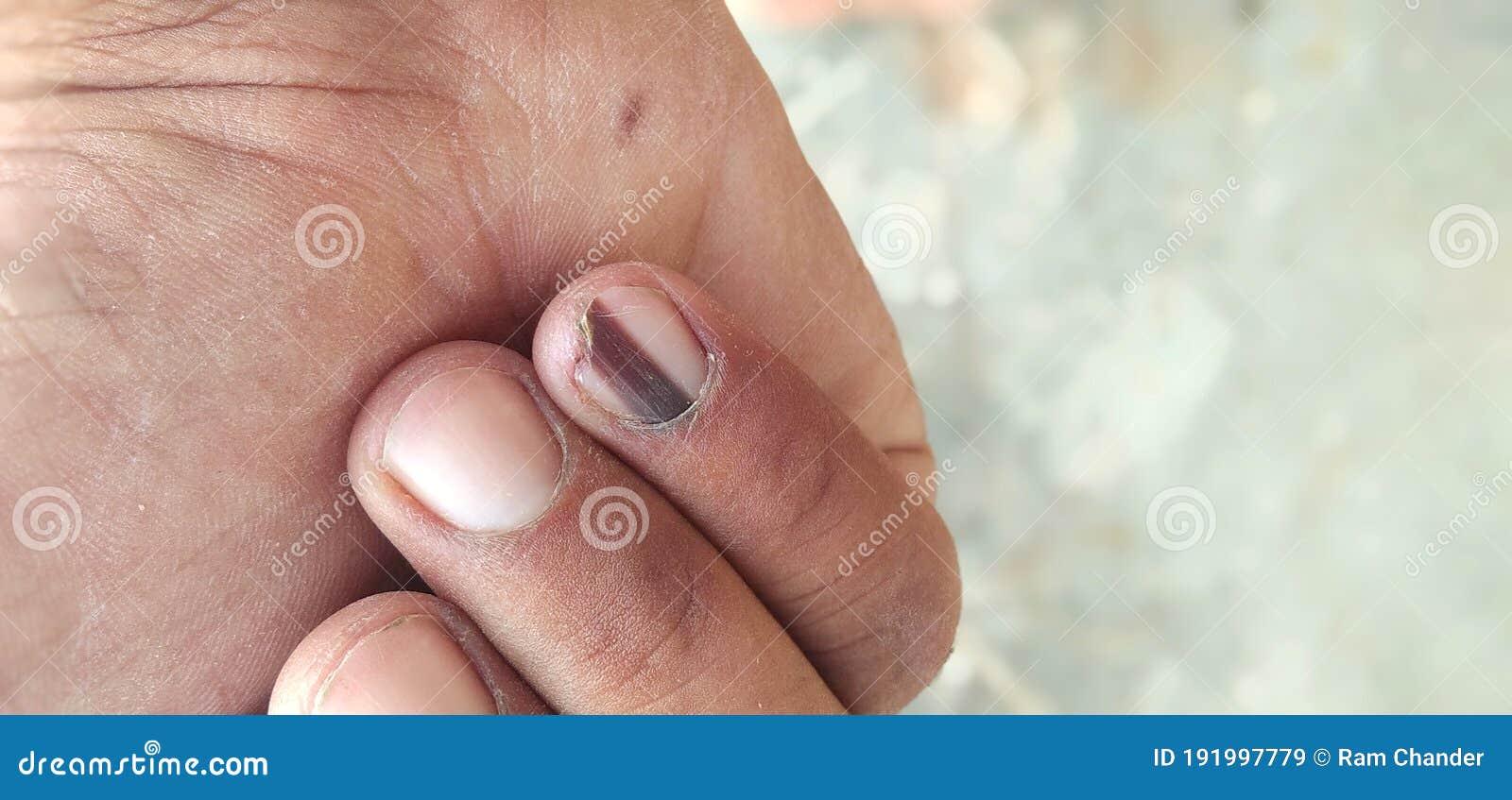 Habit Tic Nail Deformity - American Osteopathic College of Dermatology  (AOCD)