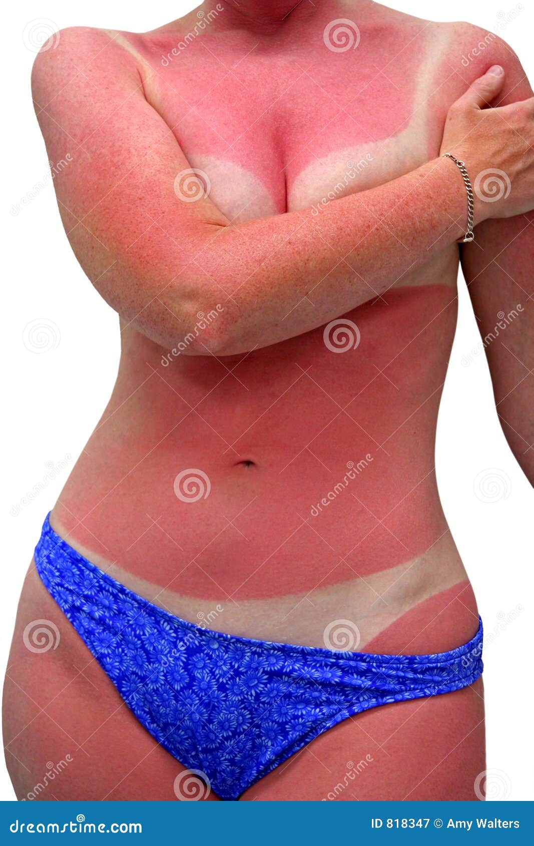 150 Bad Sunburn Stock Photos - Free & Royalty-Free Stock Photos from  Dreamstime