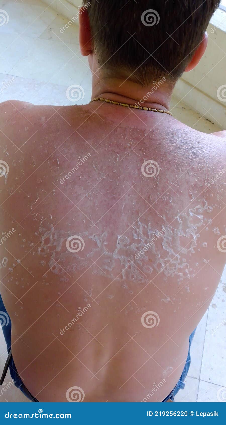 sunburn peeling back