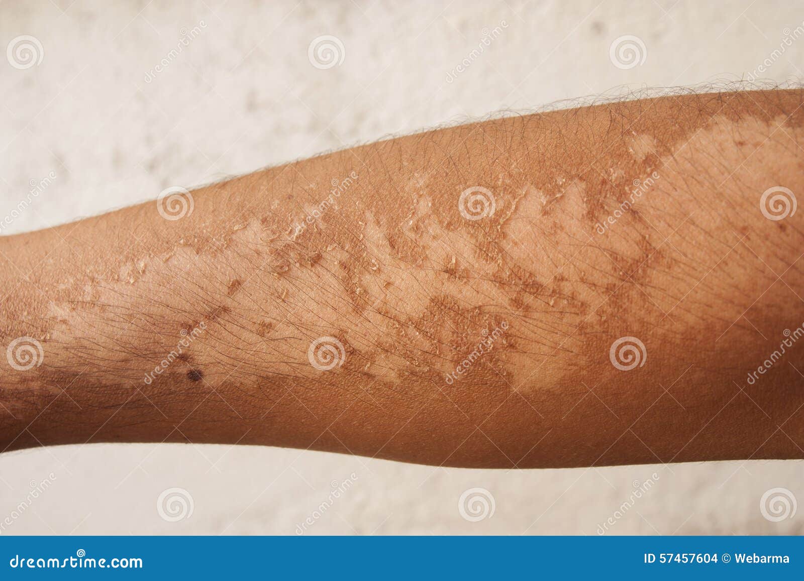 Sunburn Effects stock photo. Image of painful, body, detail 57457604