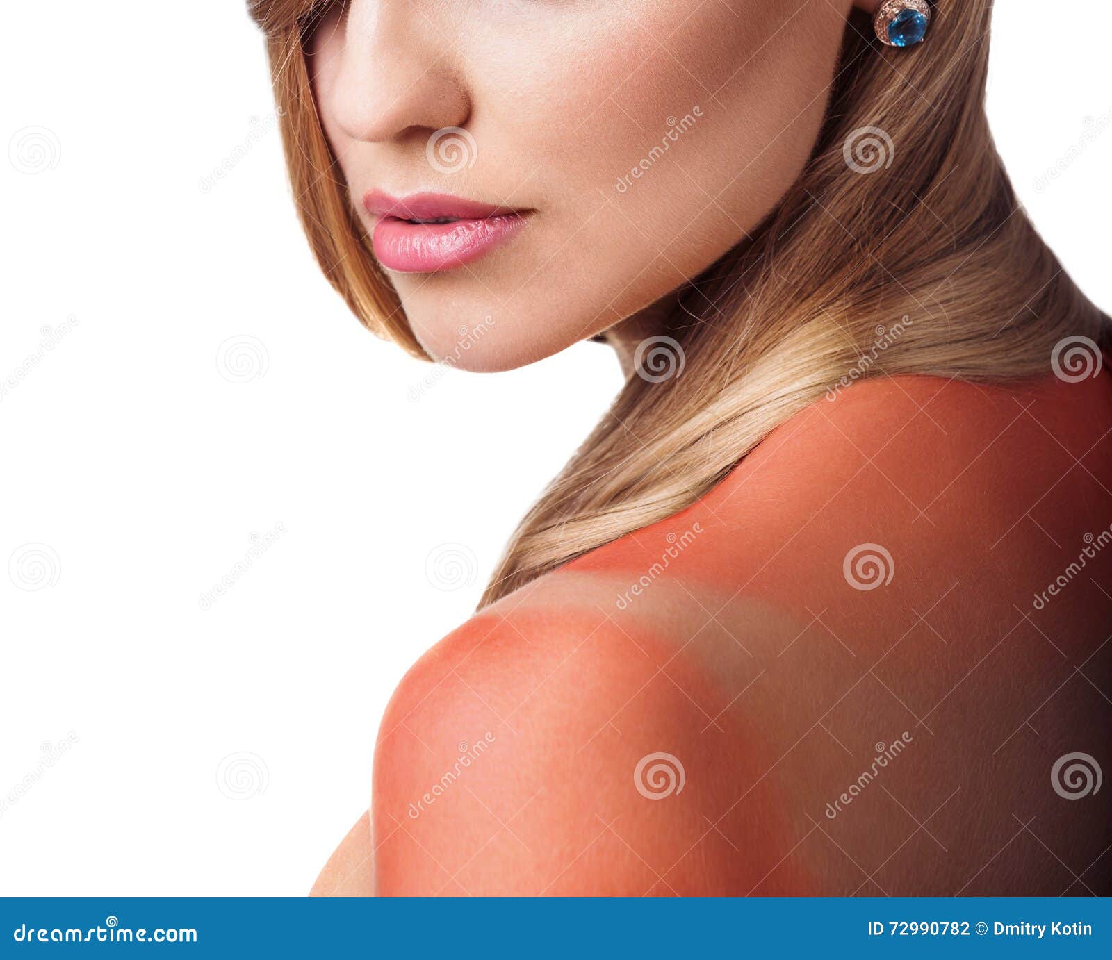sunburn female shoulder