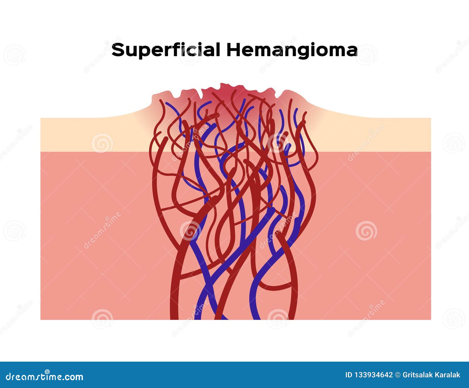 superficial hemangioma / organ and anatomy