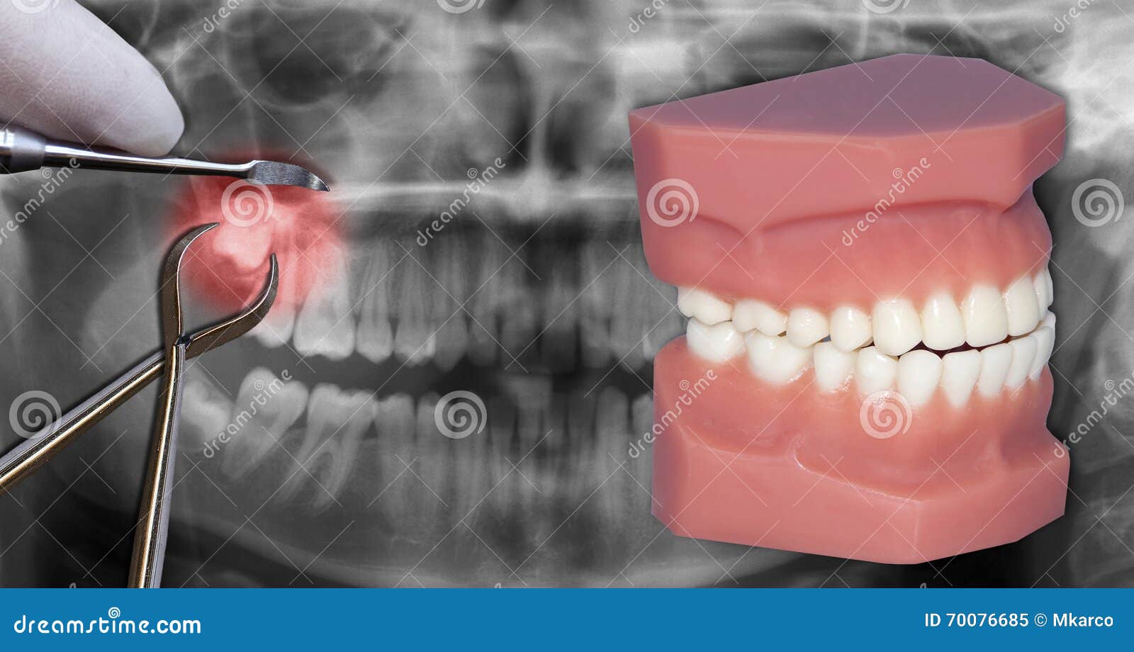 Surgery Extraction Over Xray Stock Image Image of equipment