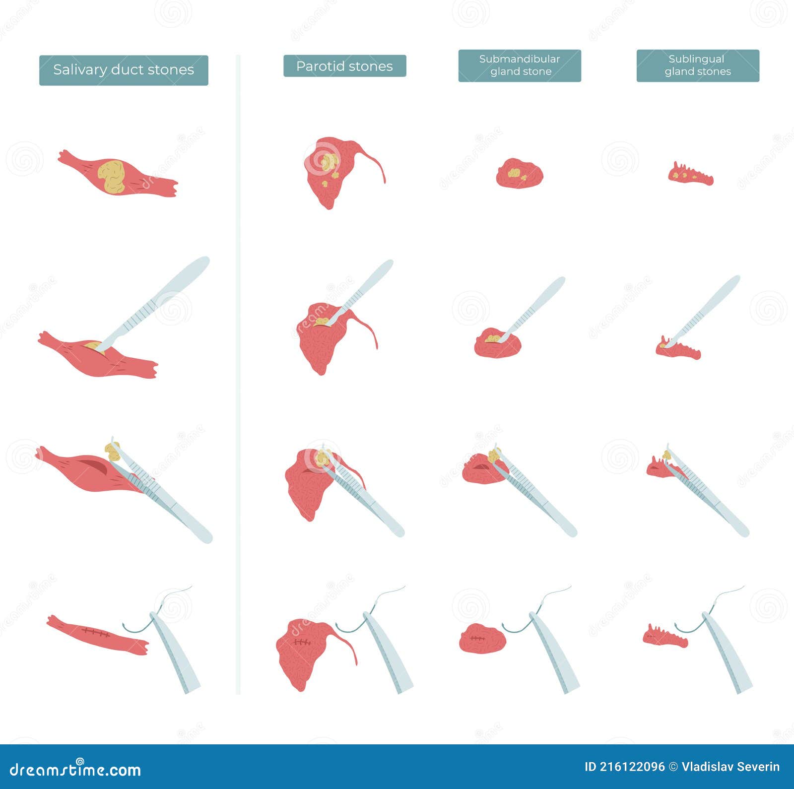 surgery to remove stones from the parotid, submandibular and sublingual salivary glands