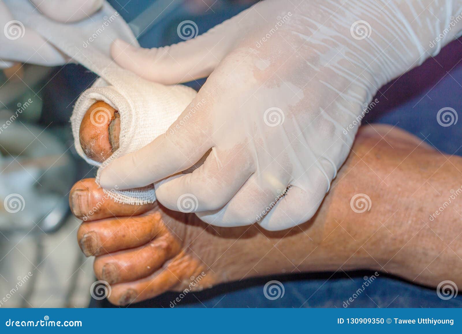 Surgical wound foot stock photo. Image of person, hospital 130909350