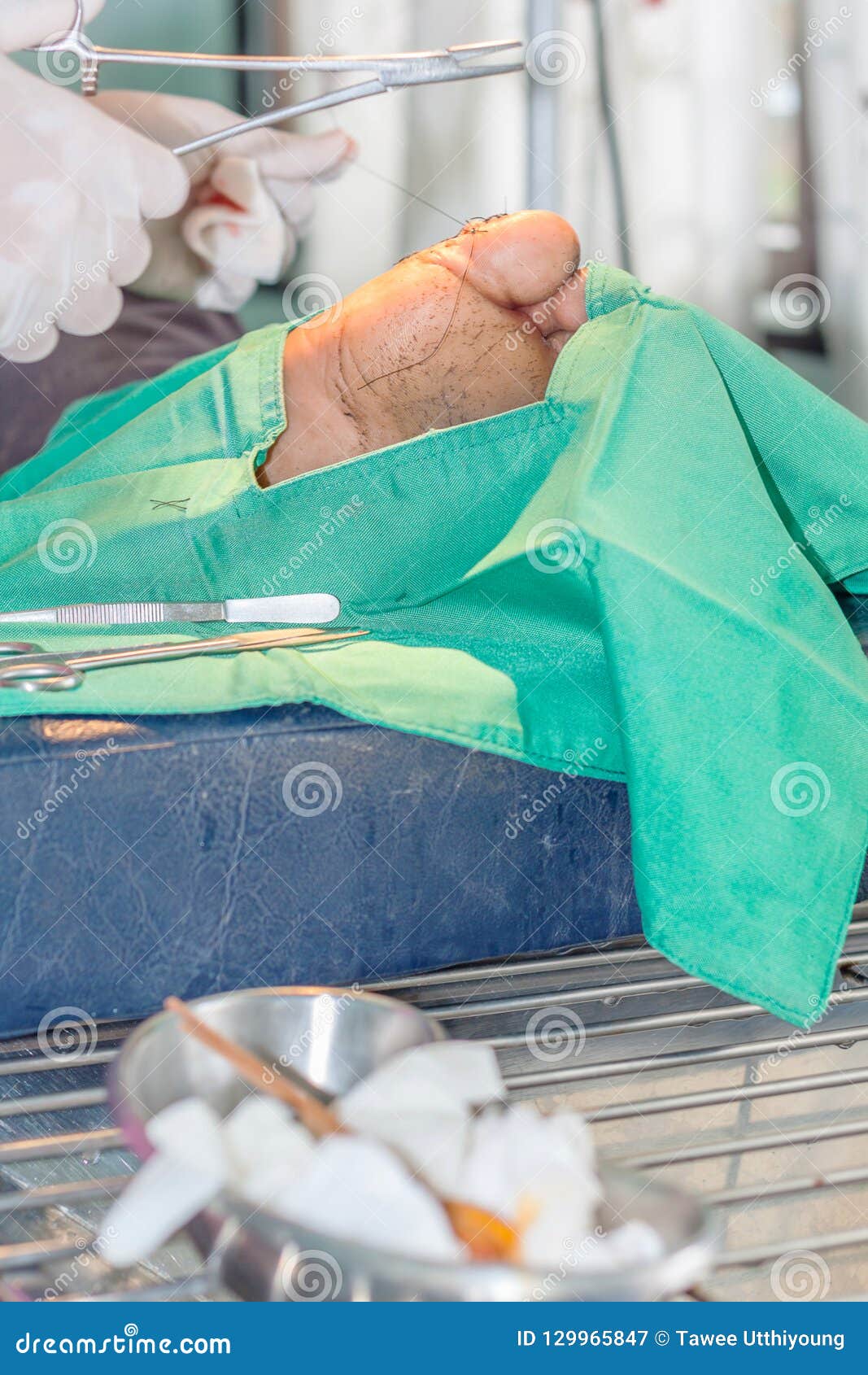 Surgical wound foot stock image. Image of patient, operation 129965847