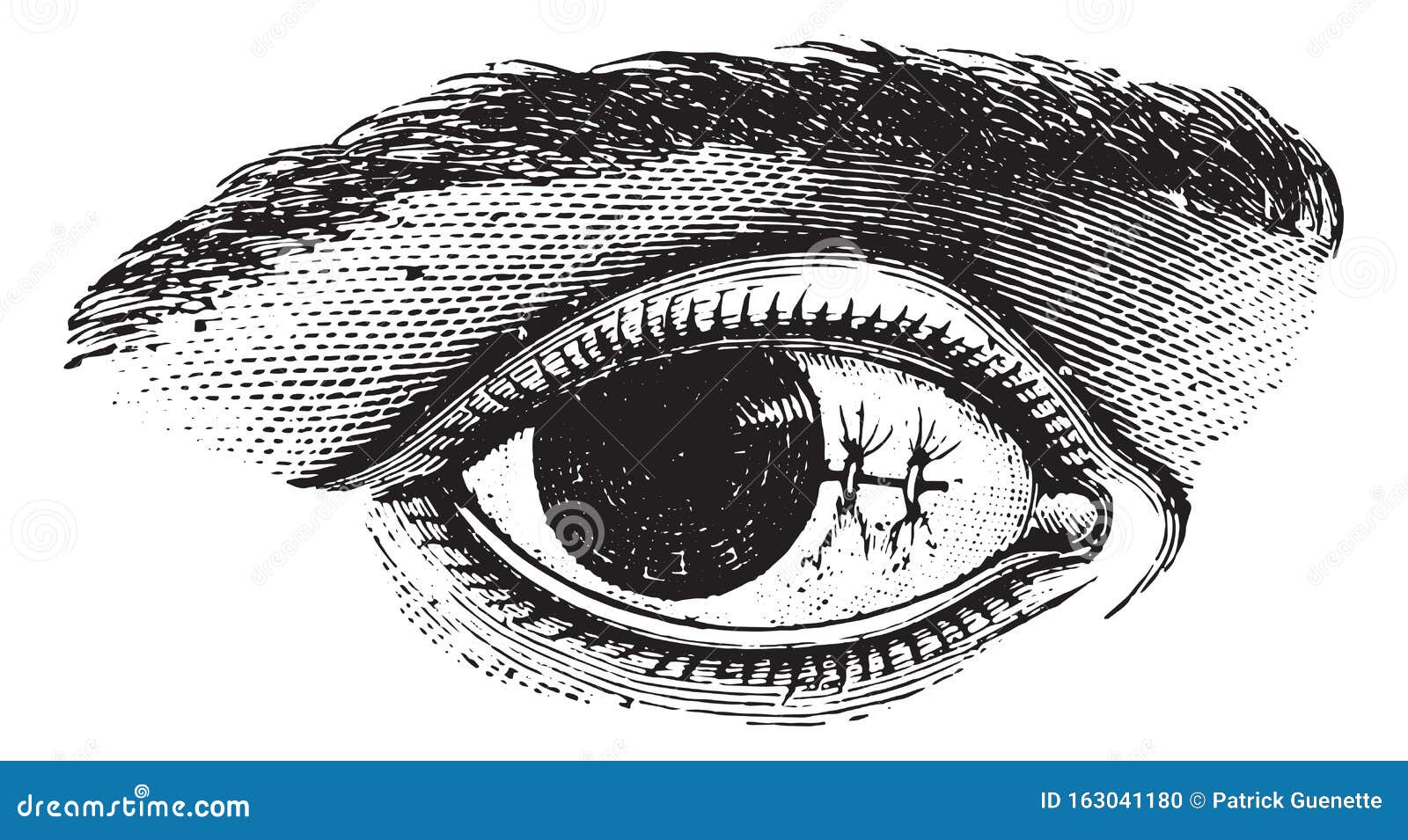 suture of the conjunctiva after excision of pterygium, vintage e