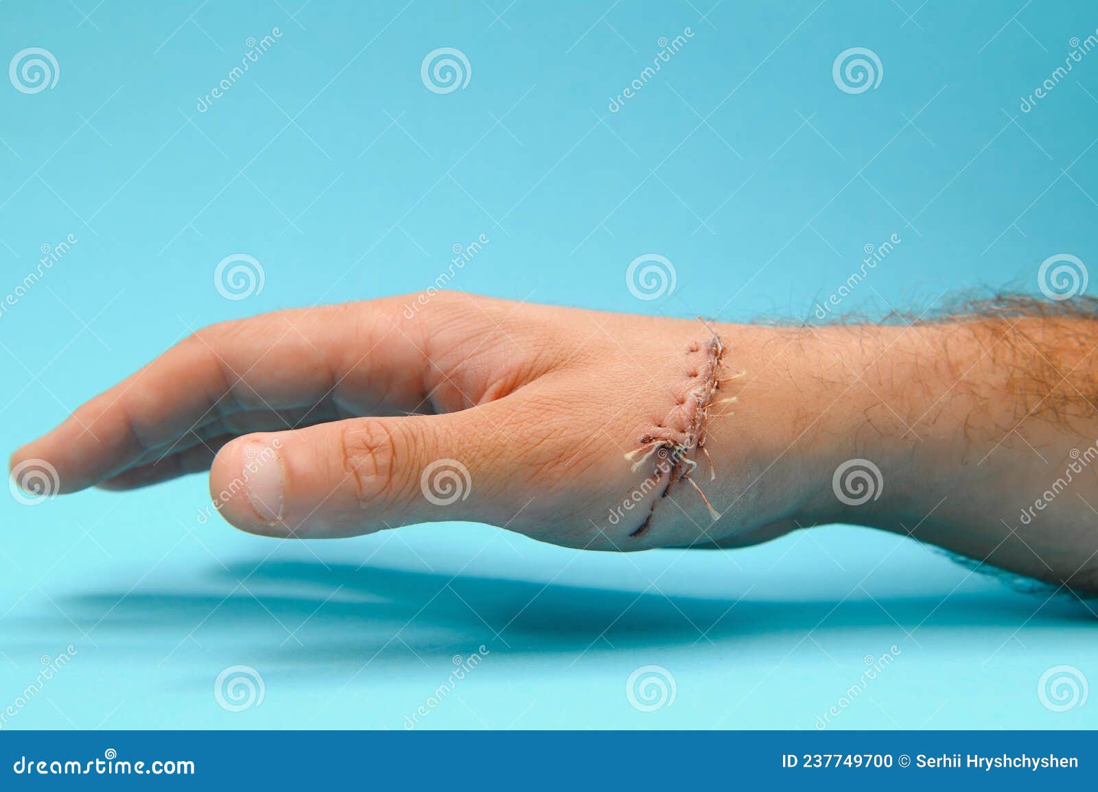 Suture Wound on Hand,Pain of Accident Concept Stock Photo Image of