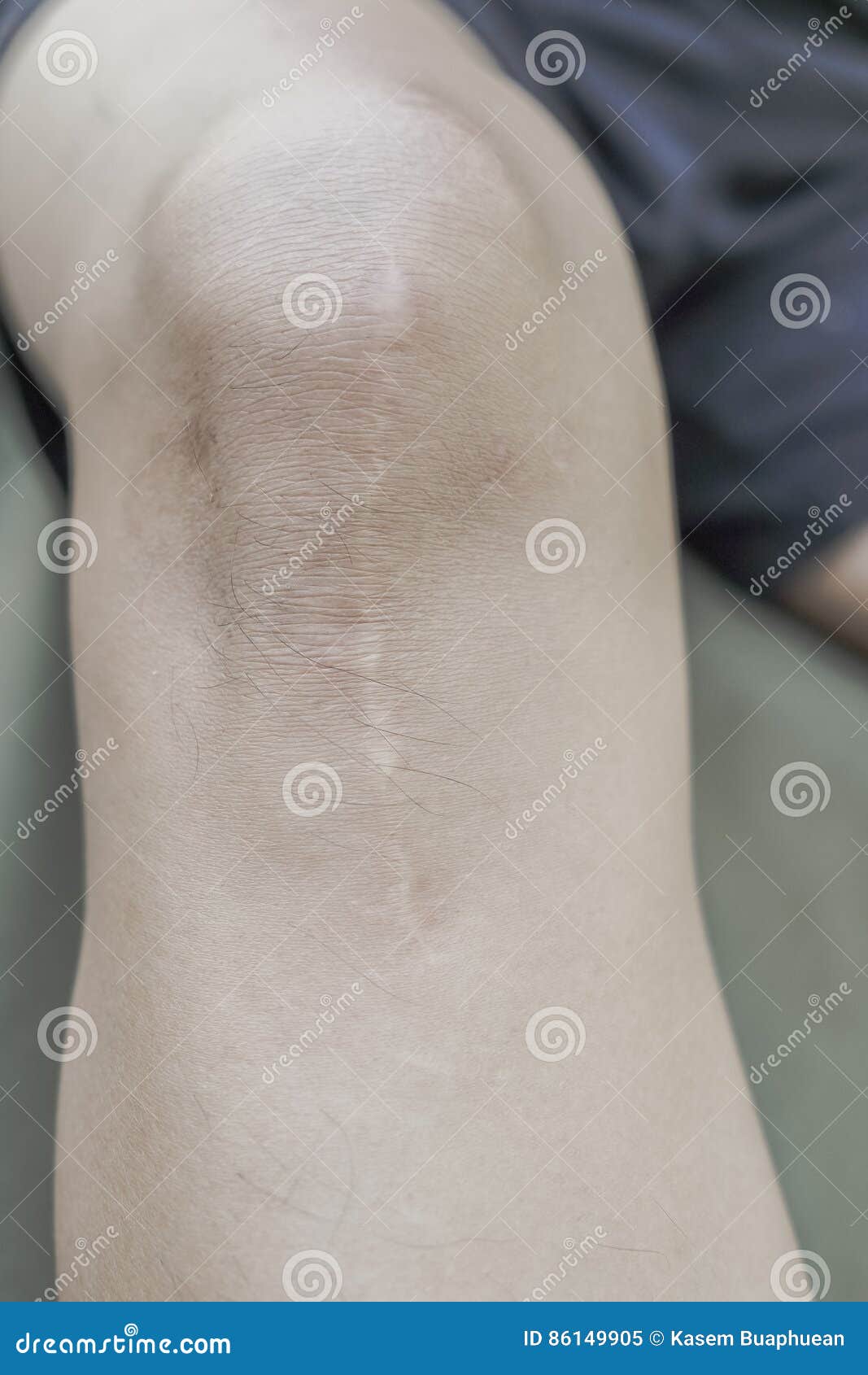 Suture Wound at Knee,knee Surgery Stock Image Image of skin, pain