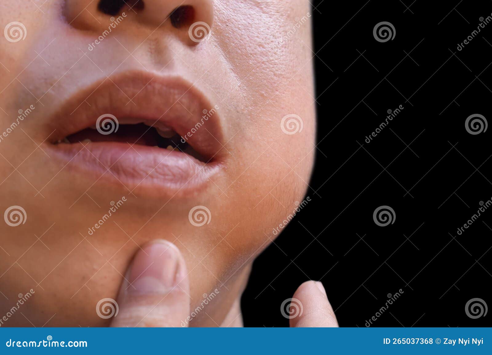 swelling at the cheek of asian man. inflammation of parotid gland called parotitis. mumps