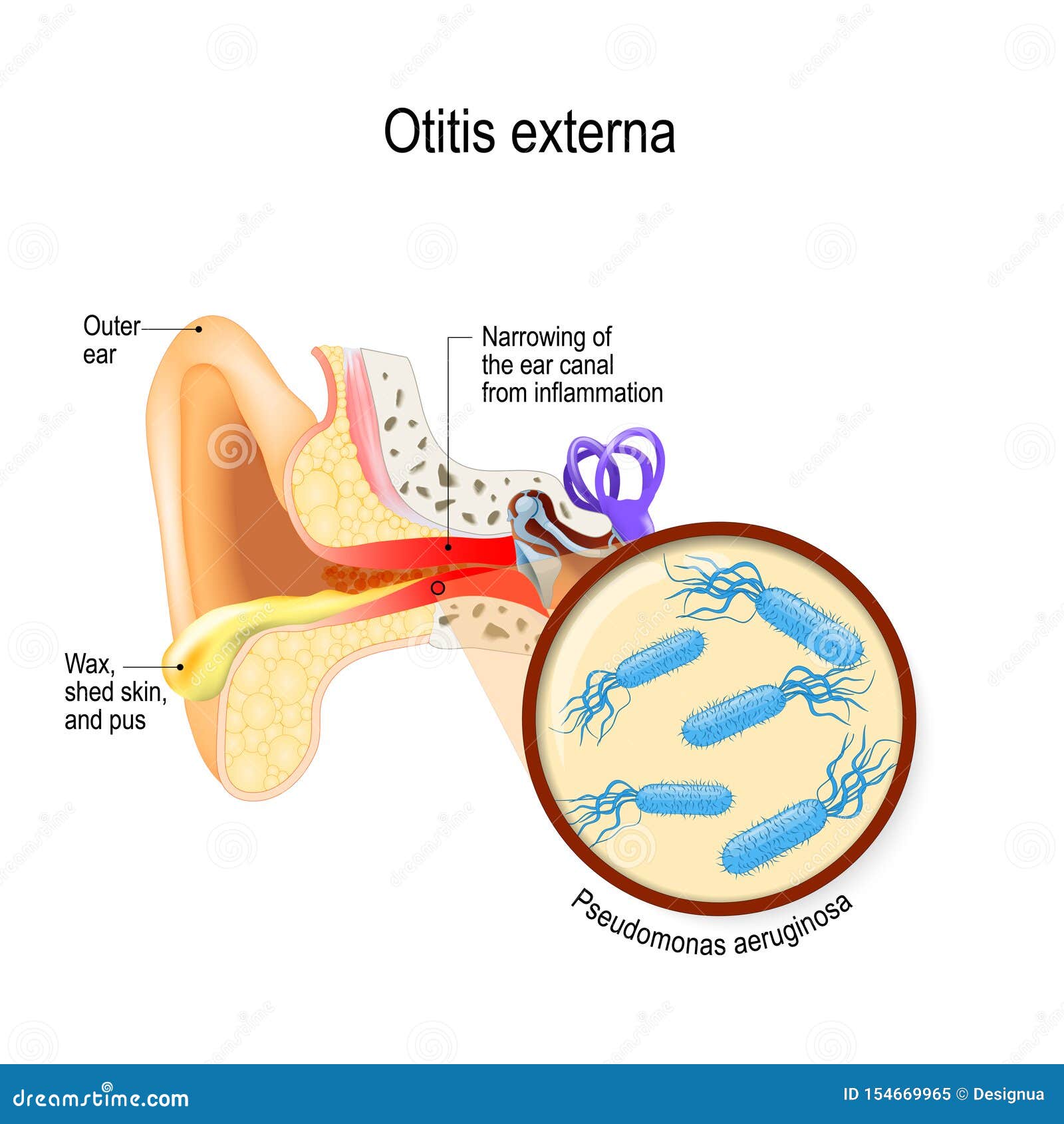 swimmer`s ear. otitis externa