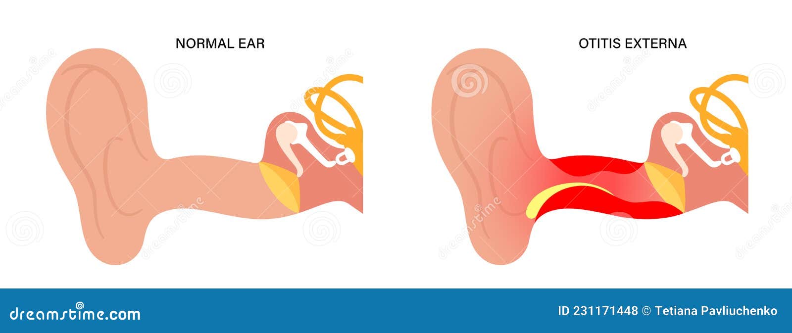 swimmers ear otitis