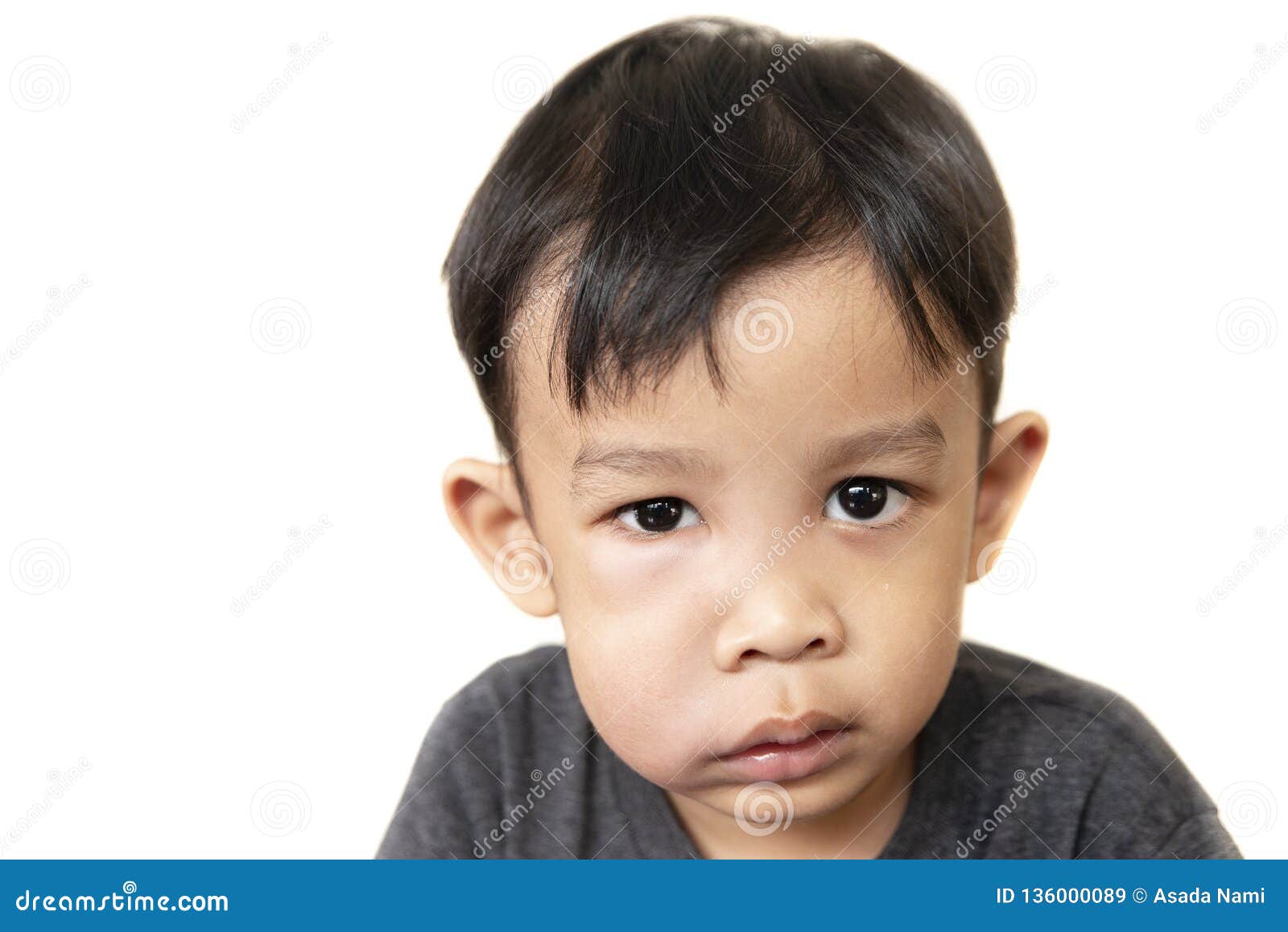 swollen face of asian kid suffering from health problem and aching tooth