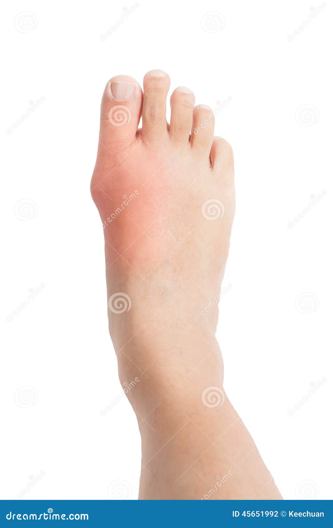Geschwollener Fuß Einseitig