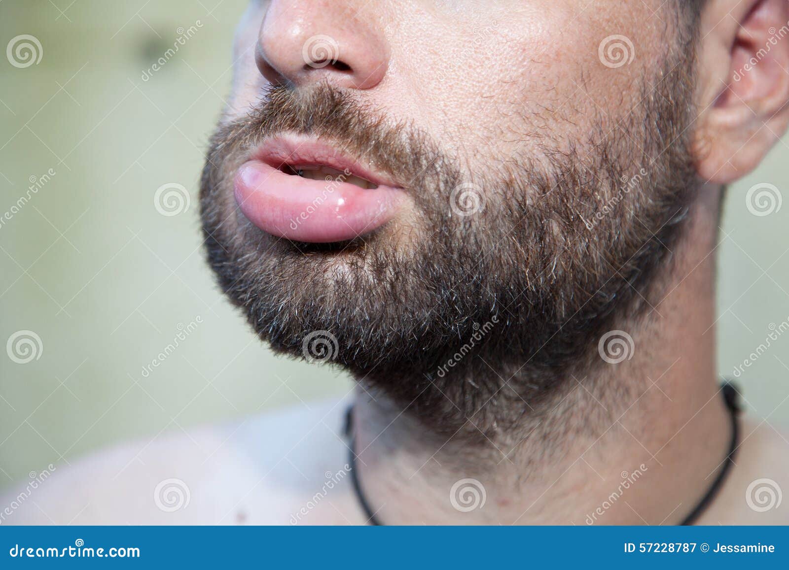 swollen lip
