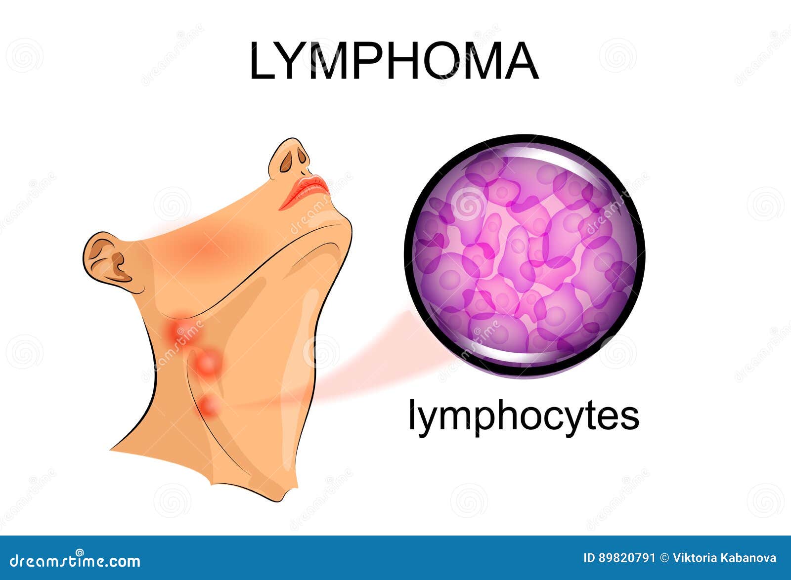 arm Correspondent Predict Swollen Lymph Nodes in Lymphoma. Oncology Stock Vector - Illustration of  healthcare, histology: 89820791