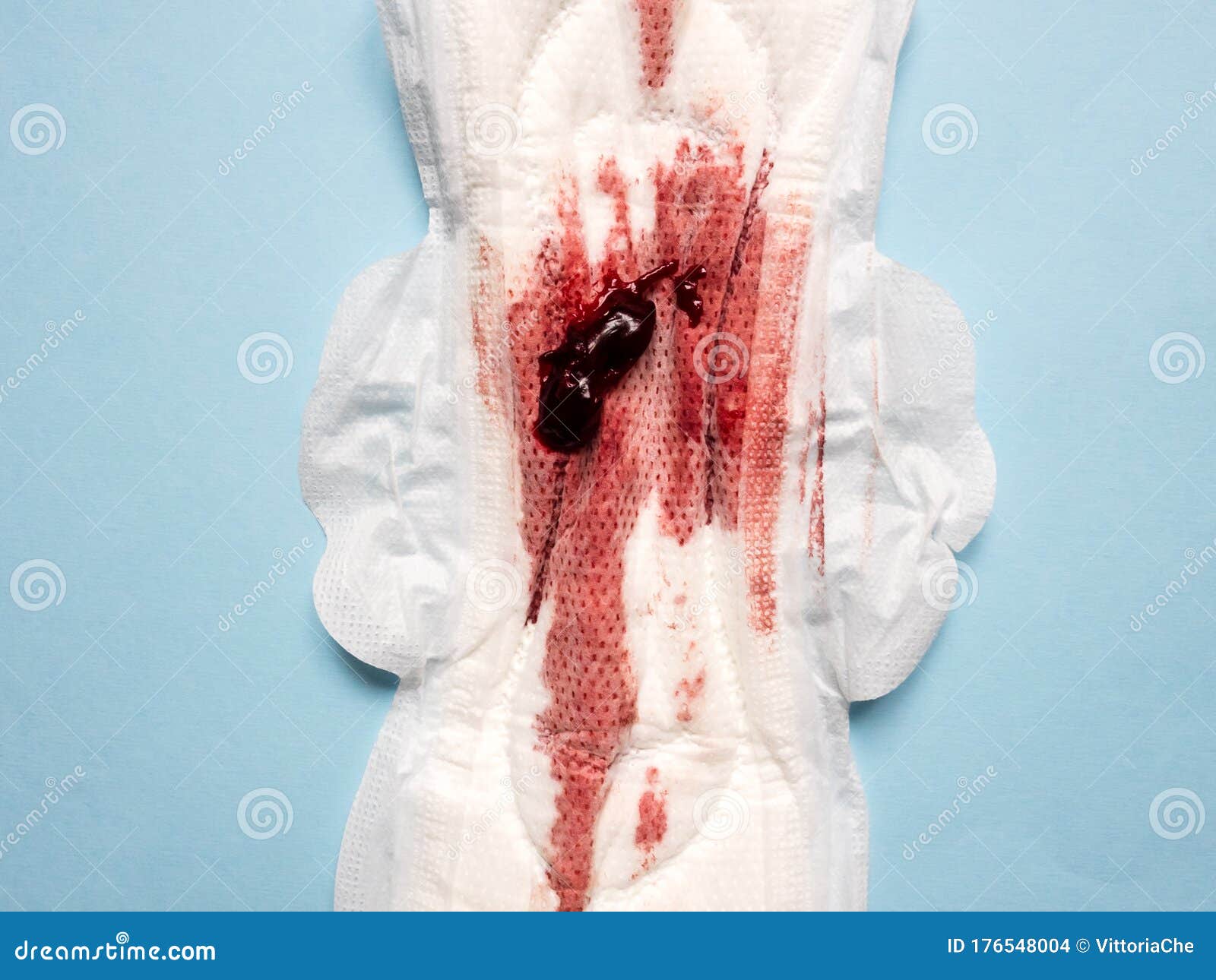 Symptom of Endometriosis, Menstrual Blood with Blood Clots on a Sanitary  Pad, Close Up Image Stock Photo - Image of medicine, endometriosis:  176548004