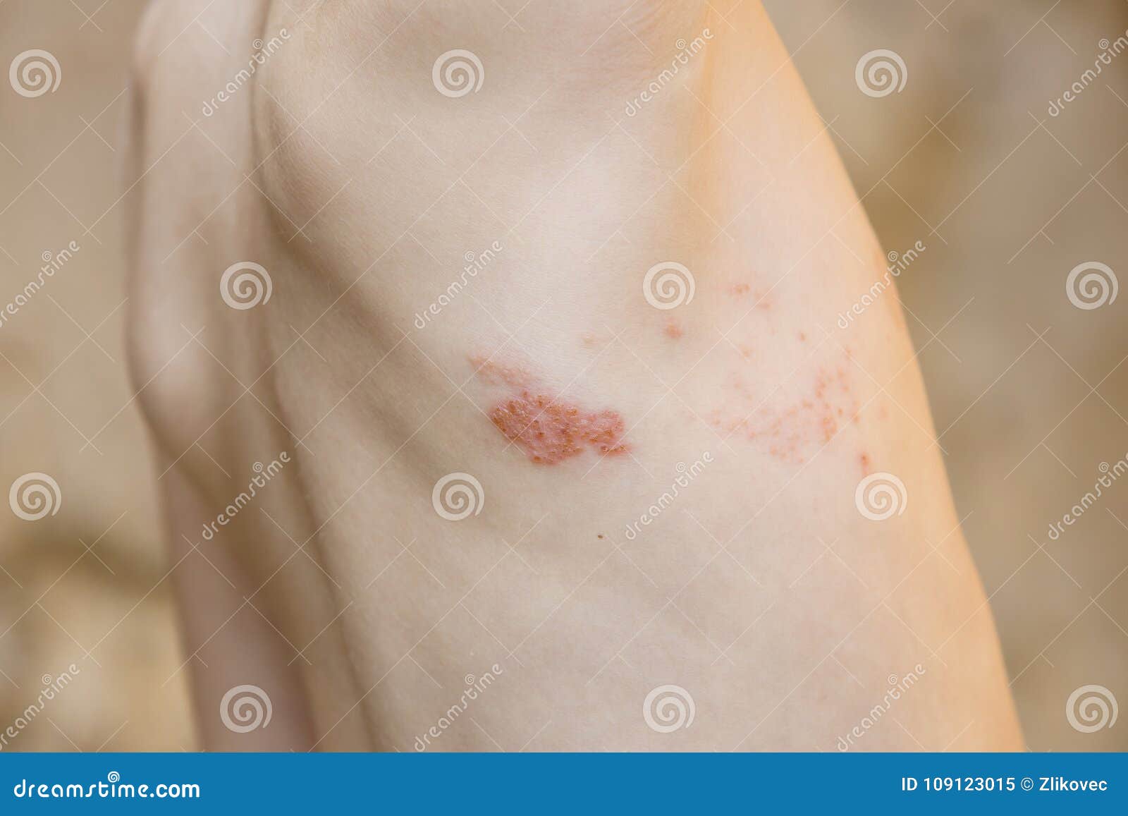symptom of herpes zoster shingles