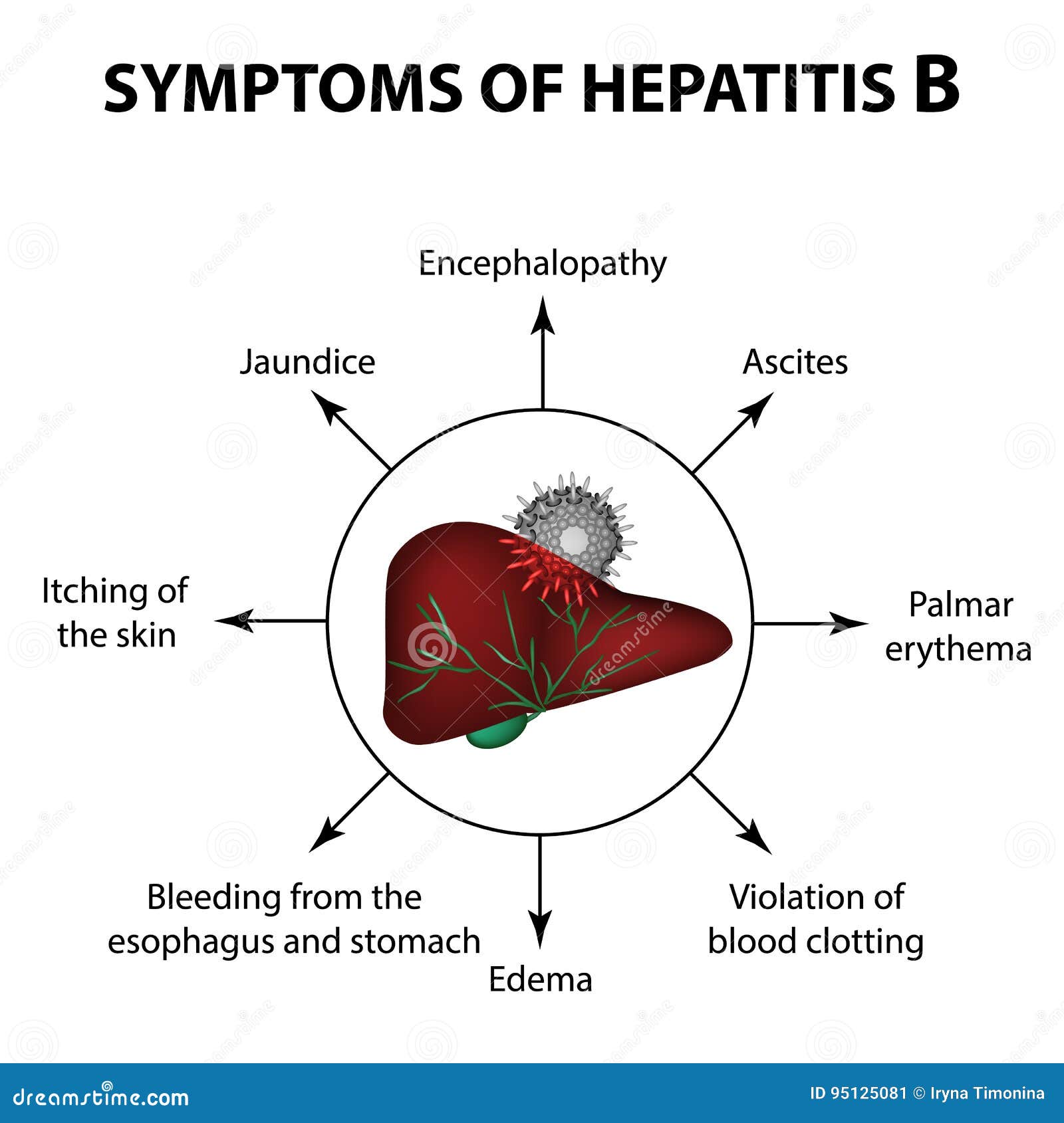 Symptome Von Hepatitis B Leber Welthepatitis Tag 28 Juli Infographics Vektorillustration Auf Lokalisiertem Hintergrund Stock Abbildung Illustration Von Detox Krankheit 95125081