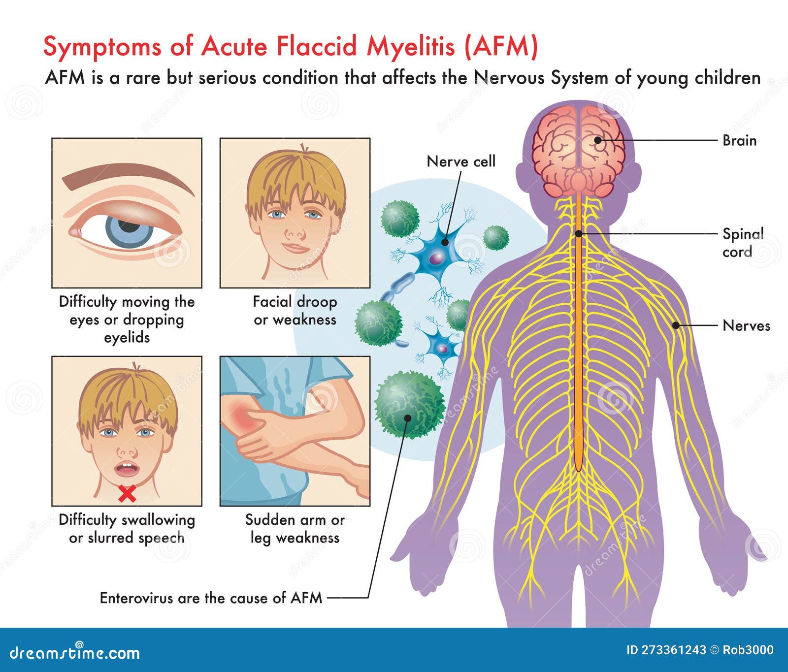 Symptoms of Acute Flaccid Myelitis or AFM Stock Vector - Illustration ...