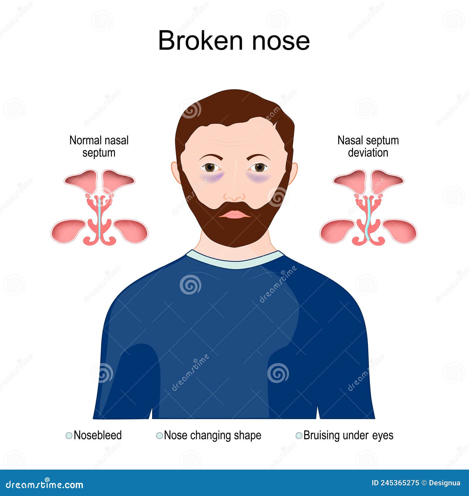 Symptoms of a broken nose stock vector. Illustration of face 245365275