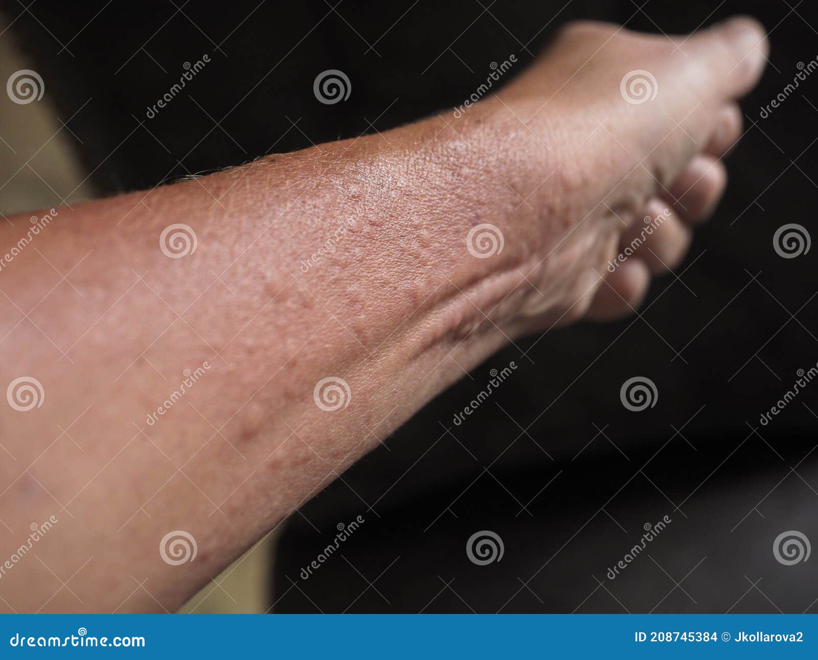 symptoms of contact allergy on hand skin
