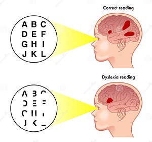 Dyslexia Vector Illustration CartoonDealer 70544144