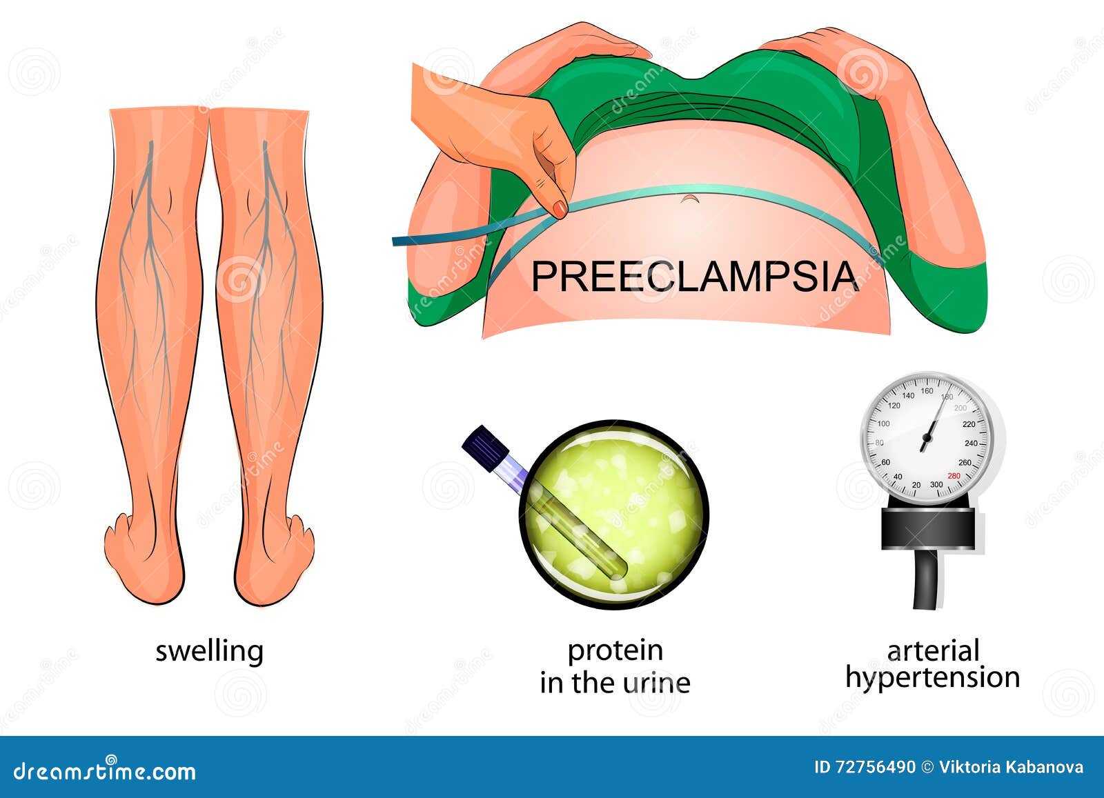 Preeclampsia Vector Illustration Labeled Pregnancy Complication Scheme normal-blood-pressure-for-pregnant-women-chart-chart-examples