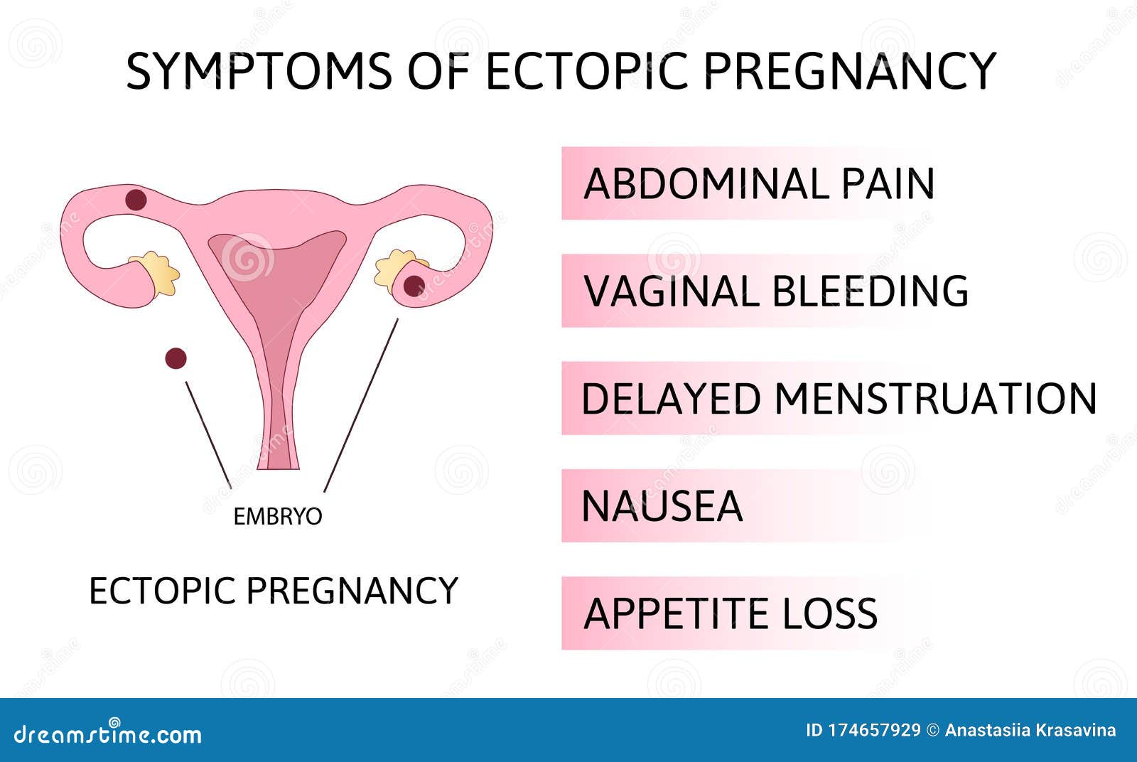 Signs and symptoms of Ectopic pregnancy