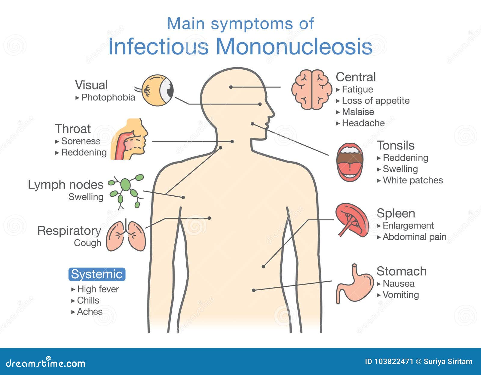 symptoms of infectious mononucleosis disease.