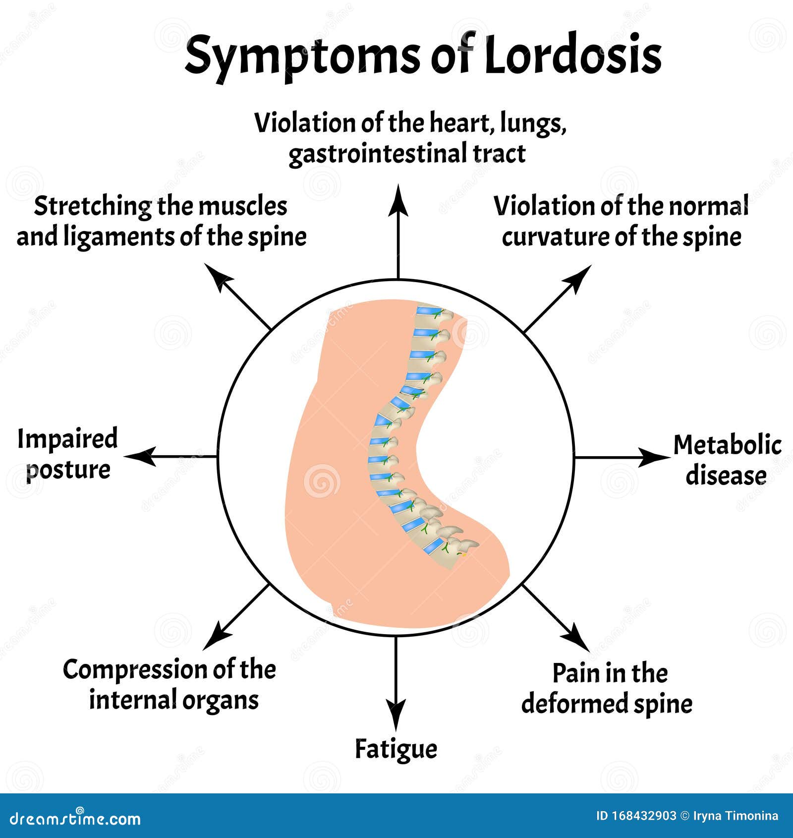 symptoms of lordosis. spinal curvature, kyphosis, lordosis, scoliosis, arthrosis. improper posture and stoop